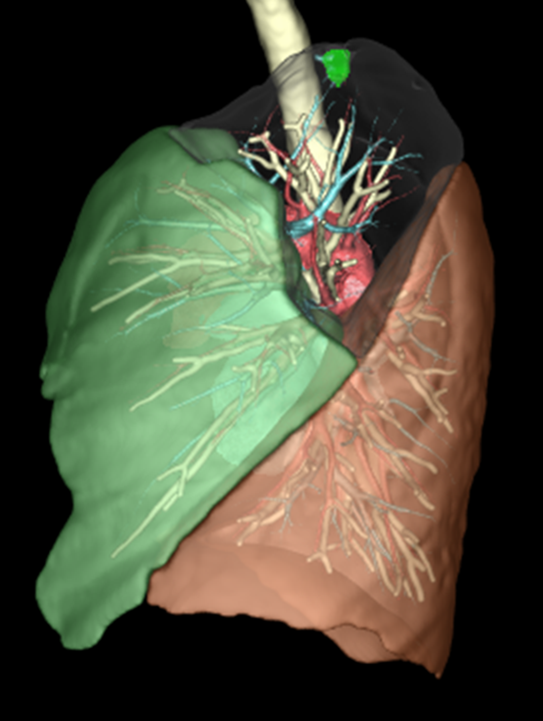 医用画像処理ワークステーション（REVOEAS）を用いた肺区域切除の３D-CTシミュレーション